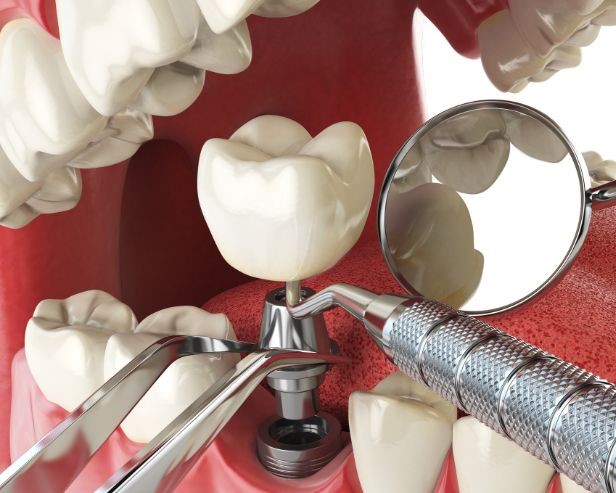 Implant Dentistry